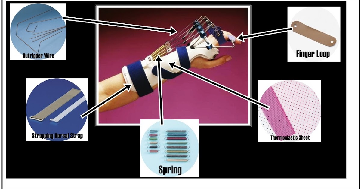 OCCUPATIONAL THERAPY The Prologue of Splinting