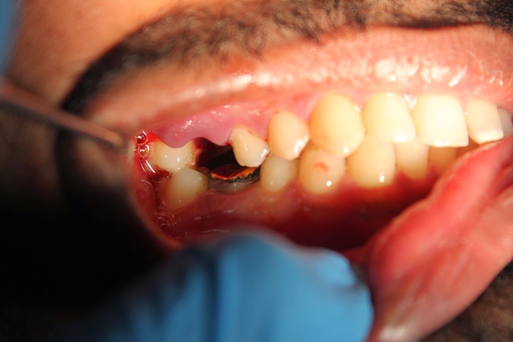 Upper decayed molar extraction and implant placement