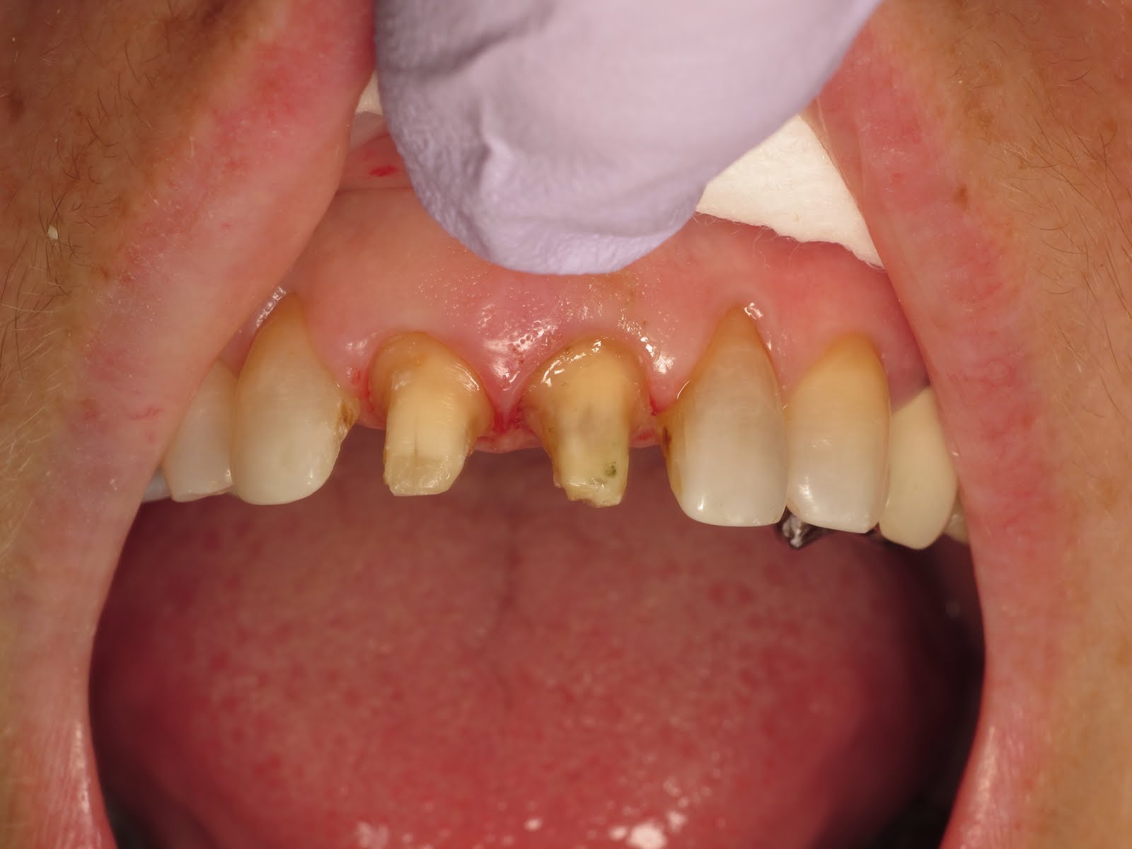 Materials for Anterior Crowns? Student Doctor Network