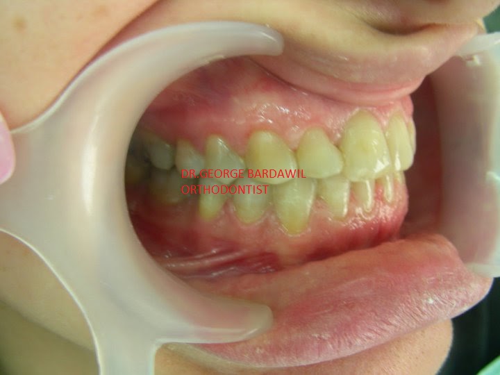 Dr.George E. Bardawil-Orthodontist-Invisalign Diamond level : CLASS 3
