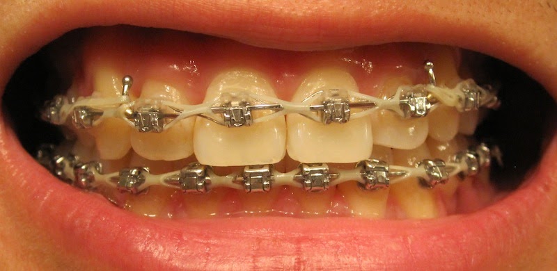 braces damon week journey