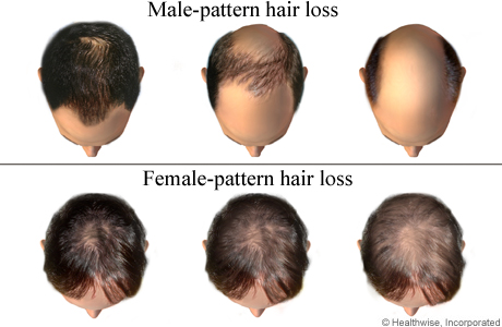 Journey With Sonny Like A Boss Hair Loss What Happen