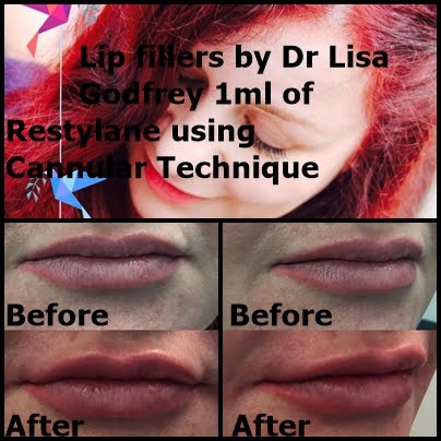 Lip Fillers By Dr Lisa Godfrey