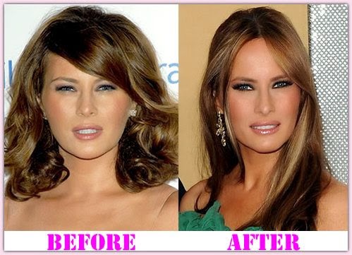 Melania%2BTrump%2BPlastic%2BSurgery%2BBefore%2B%26%2BAfter.jpg