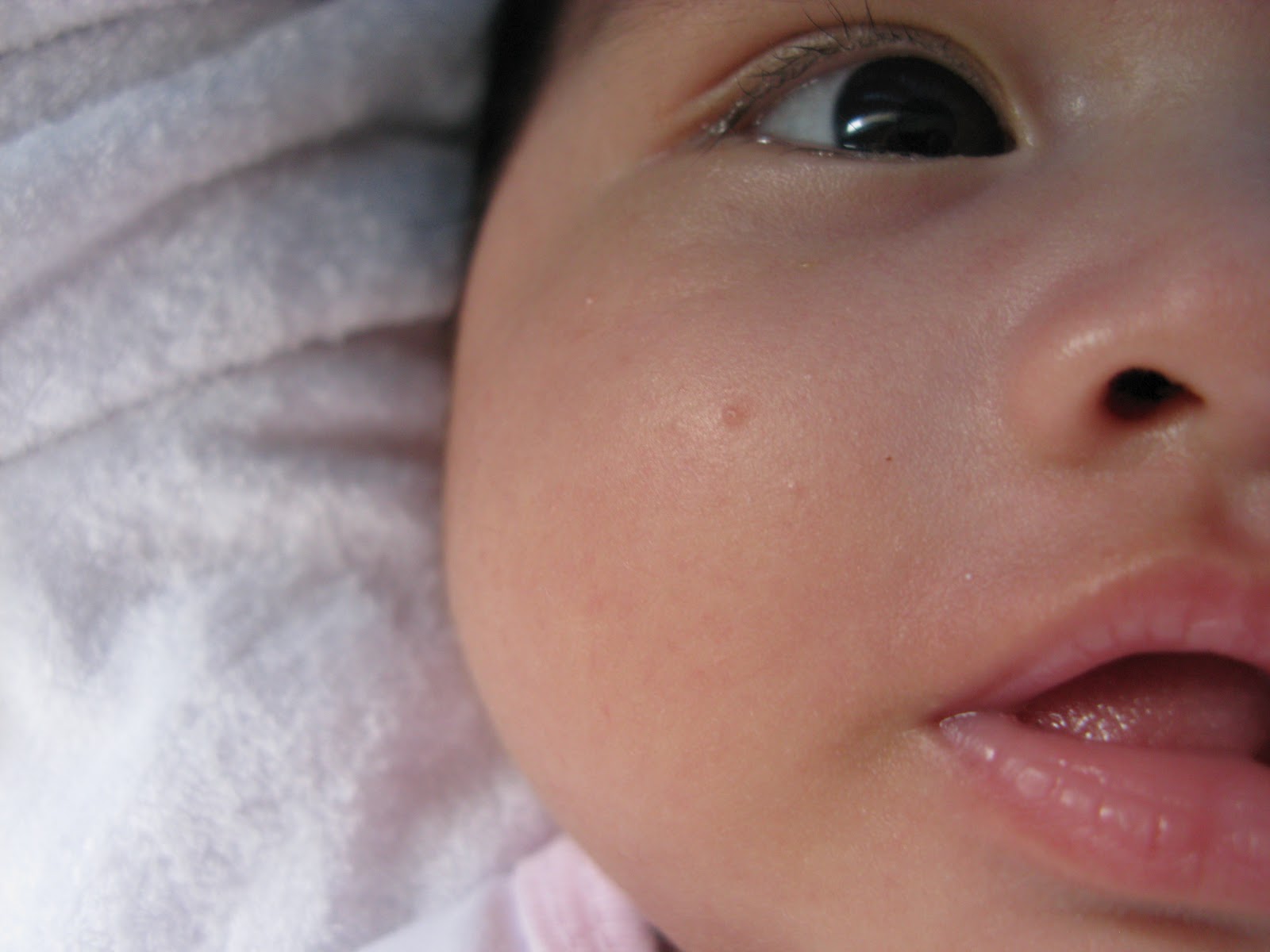 rash on baby
