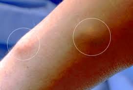 Steroid injection painful lump