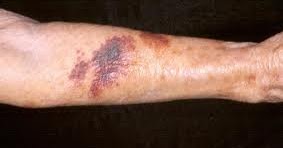 bruises on legs for no reason bruises on legs for no reason