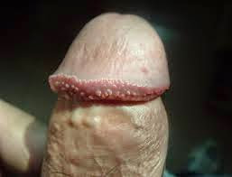 kutil kelamin dipenis kutil kelamin dipenis