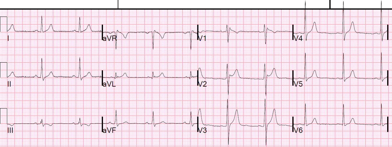 Dr Smith S Ecg Blog Is This Type 2 Brugada Syndrome Ecg Pattern