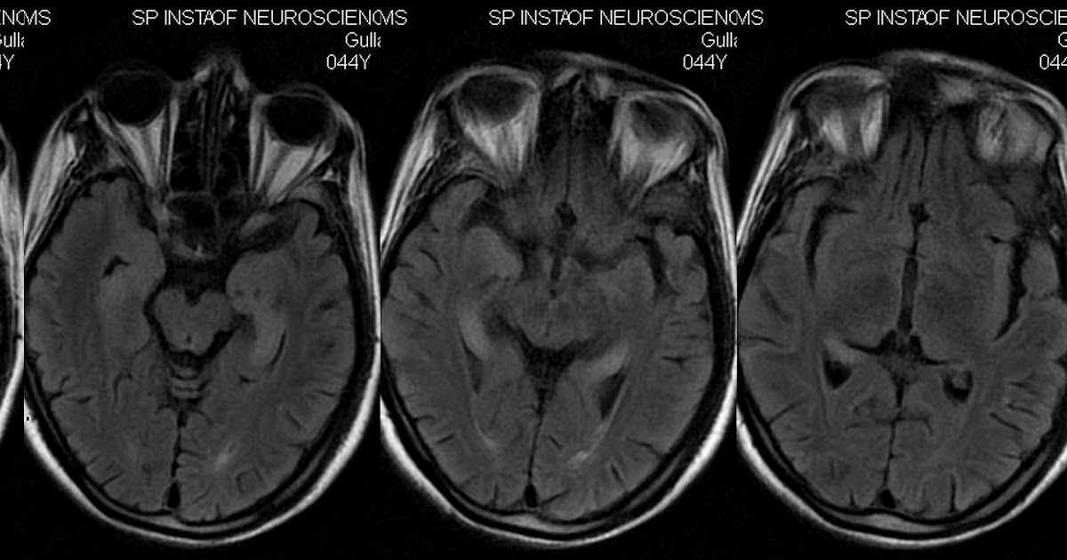 Neuroradiology Cases: Limbic Encephalitis