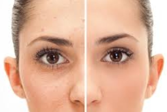 Bagaimana Cara Menghilangkan Flek Hitam Bekas Jerawat Agar Tampil Cantik Dan Sempurna Bagaimana Cara Menghilangkan Flek Hitam Bekas Jerawat Agar Tampil Cantik Dan Sempurna