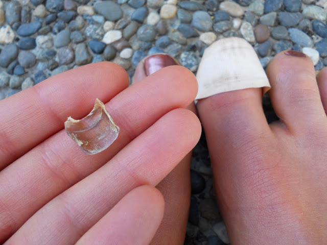 Snacking Squirrel When Toenails Fall Off