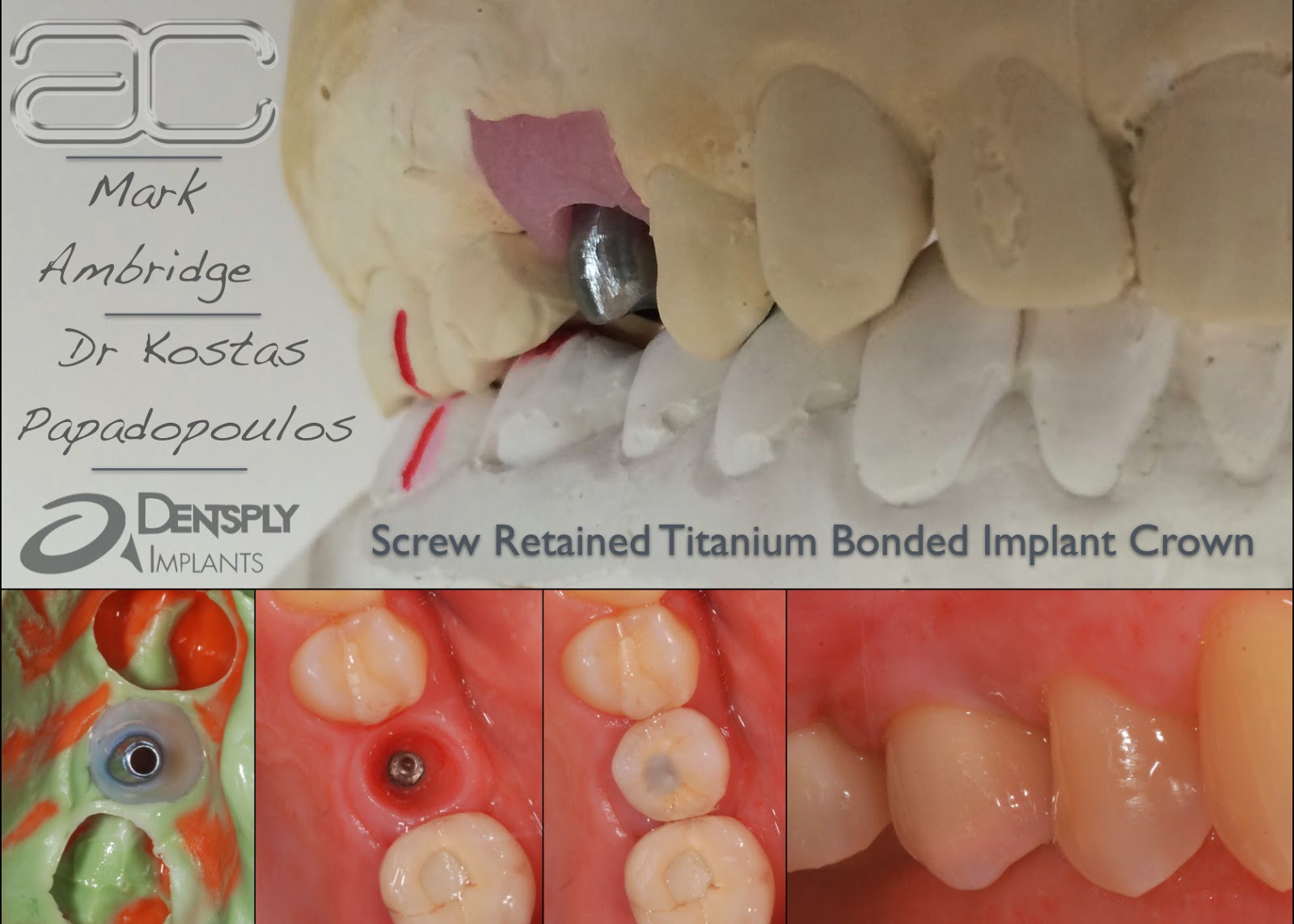 ambridge ceramics Titanium screw retained implant crowns