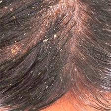 How do you get rid of dry scalp?