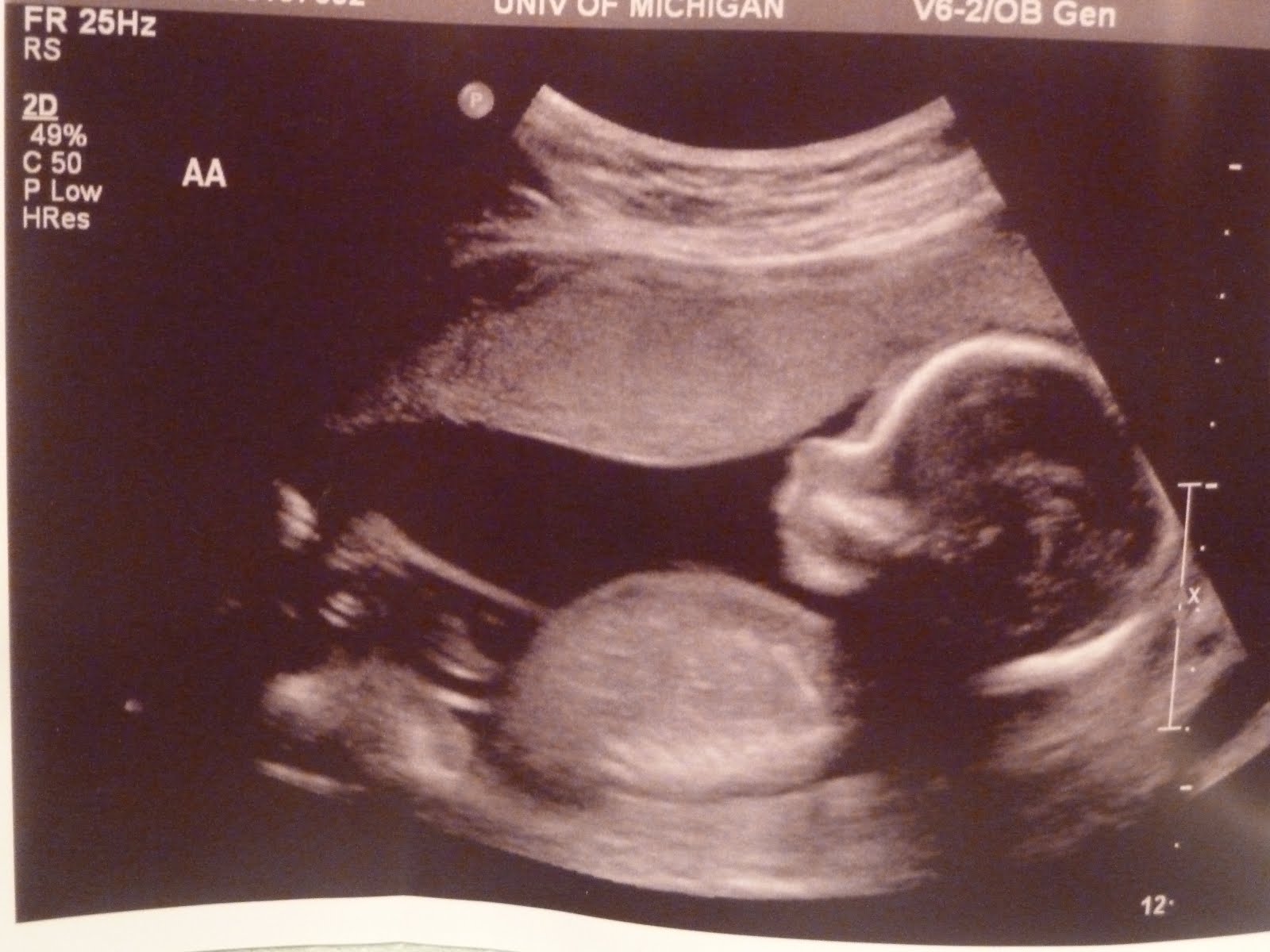 Baby Bitty Twins: 18 week ultrasound pics