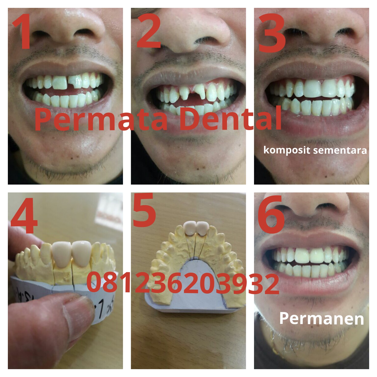 AHLI GIGI PALSU BALI PERMATA DENTAL Porcelain crowns Gigi crown
