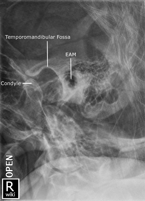 ON RADIOLOGY Temporomandibular Joints (TMJ) Radiographic Anatomy