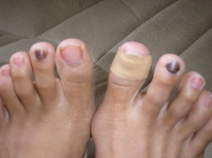Runner Toe