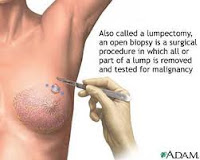 lumpectomy biopsy 