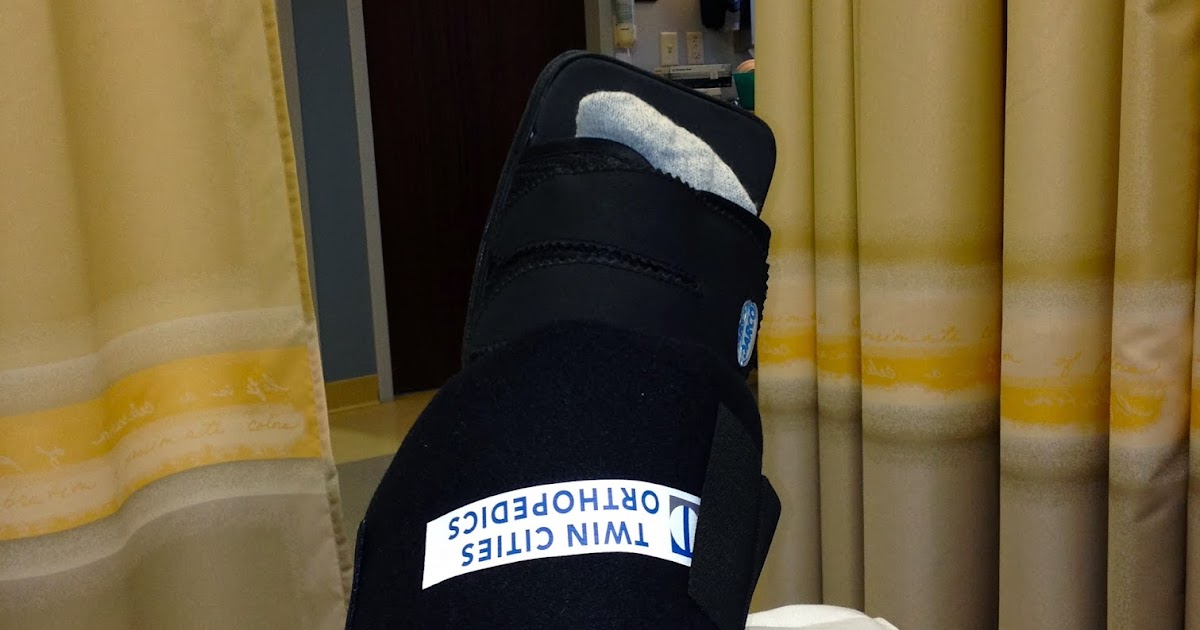 After LisFranc Surgery Lisfranc Hardware removal surgery