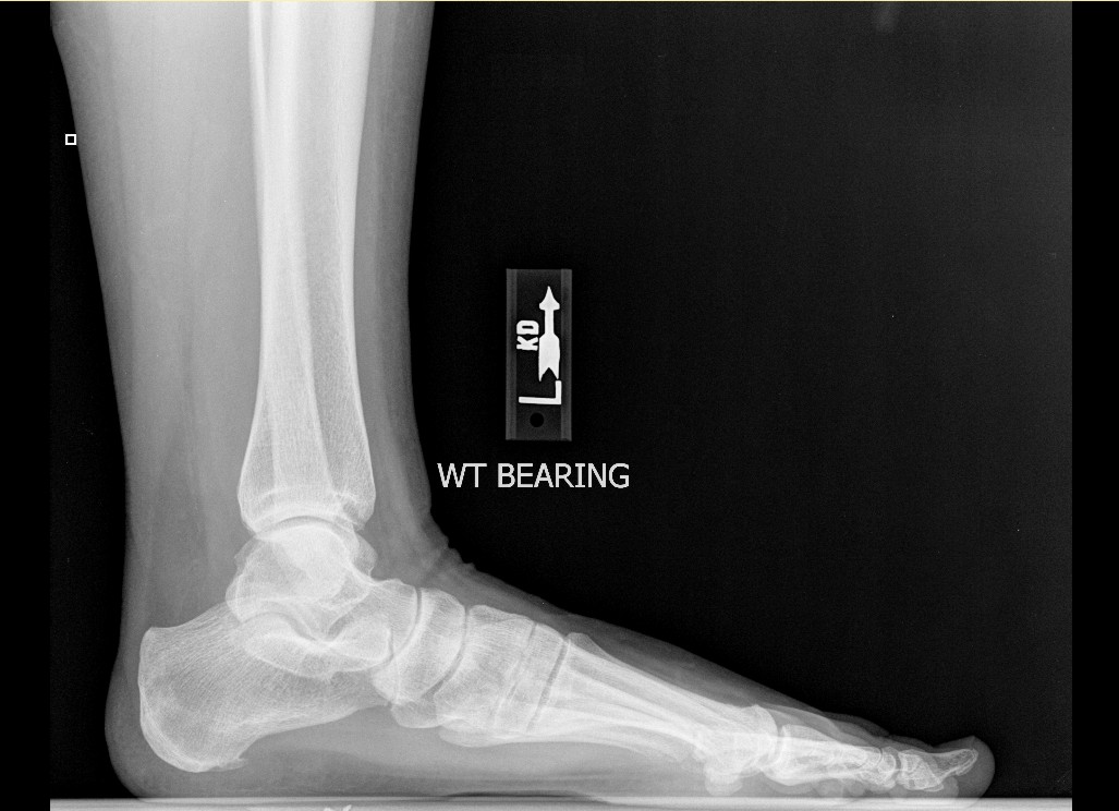 My posterior tibial tendon surgery journey The injury