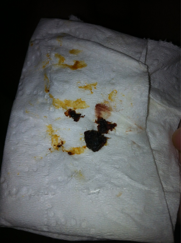 This just fell out of my ear. Now I can hear correctly popping