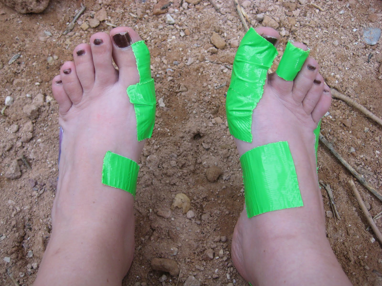 Ingrown toenail home treatment mayo, how to treat a sore on bottom of