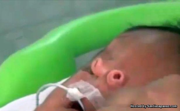 Baby Angelito, Bayi Pelik Lahir Dengan Hidung Sesungut Baby Angelito