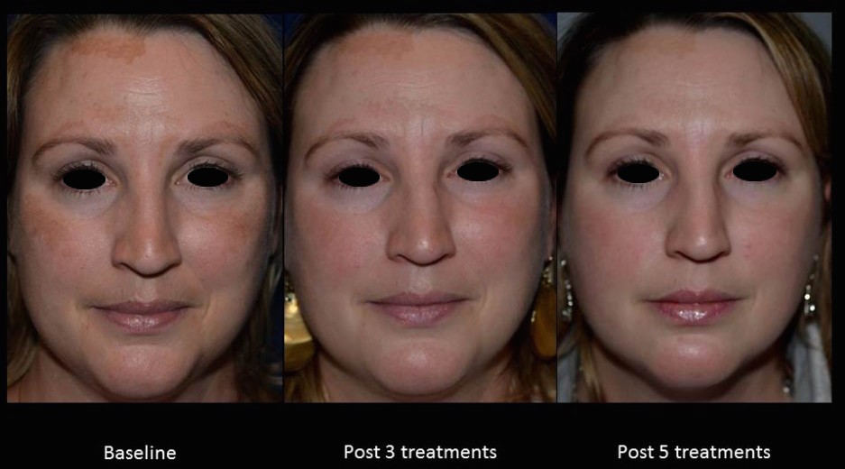 DermaSphere Black Doll Celebrity Facial