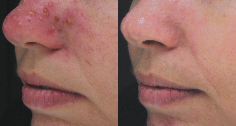 Accutane To Help Blackheads
