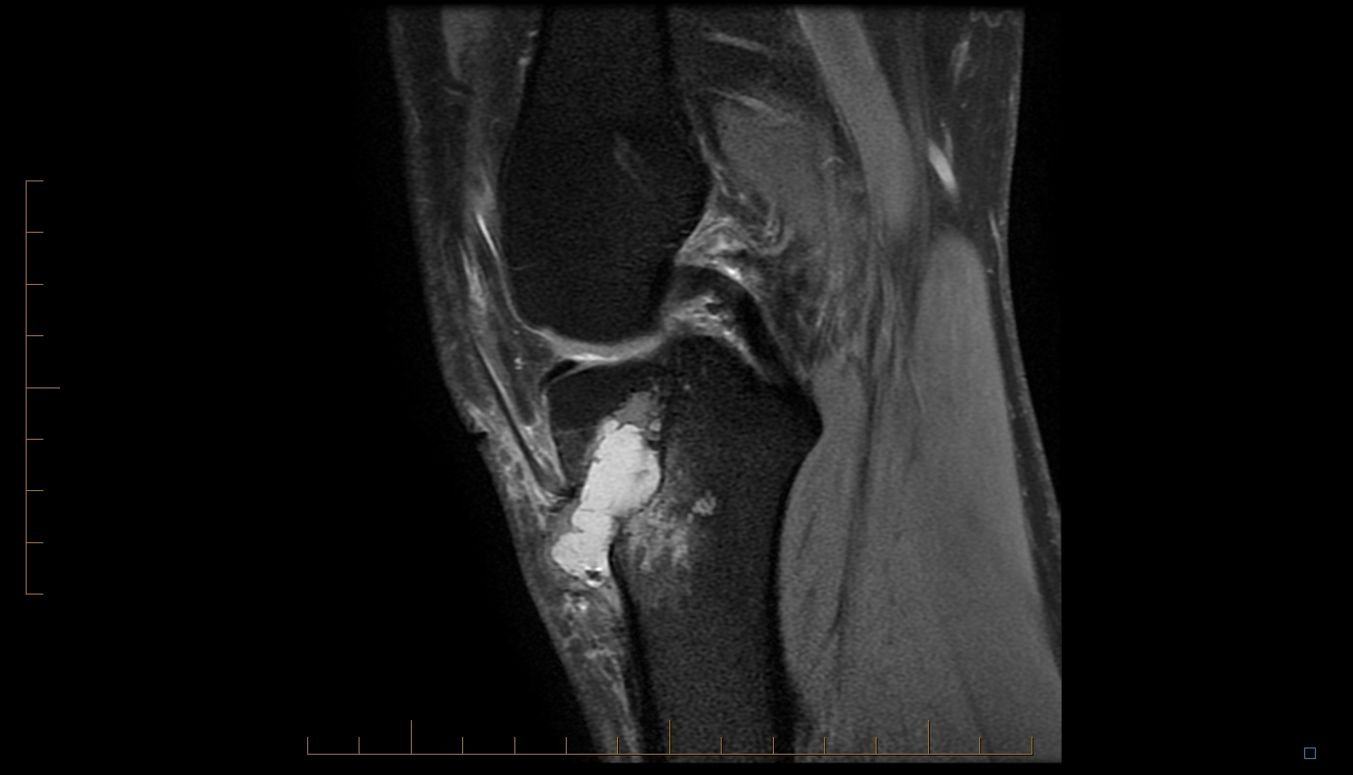 Radiology Cases Tibial Tunnel Cyst post ACL Recon (II)