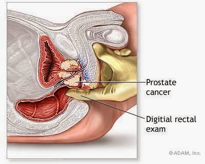 obat alami kanker Prostat stadium 1, obat kanker prostat, pengobatan kanker prostat