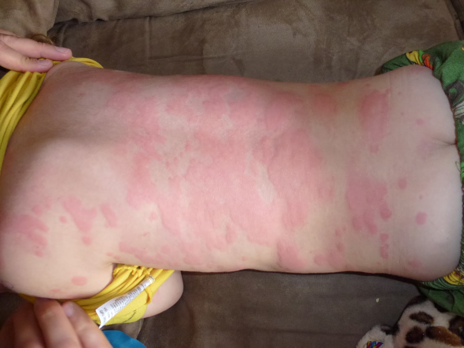 Clausen in the Hausen & out in the Garden rash two hours after new