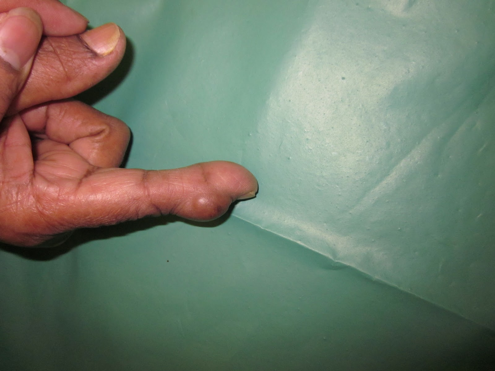Tumor On Finger