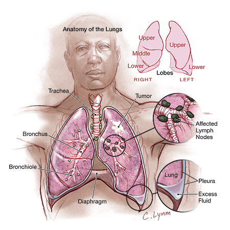 lung cancer symptoms