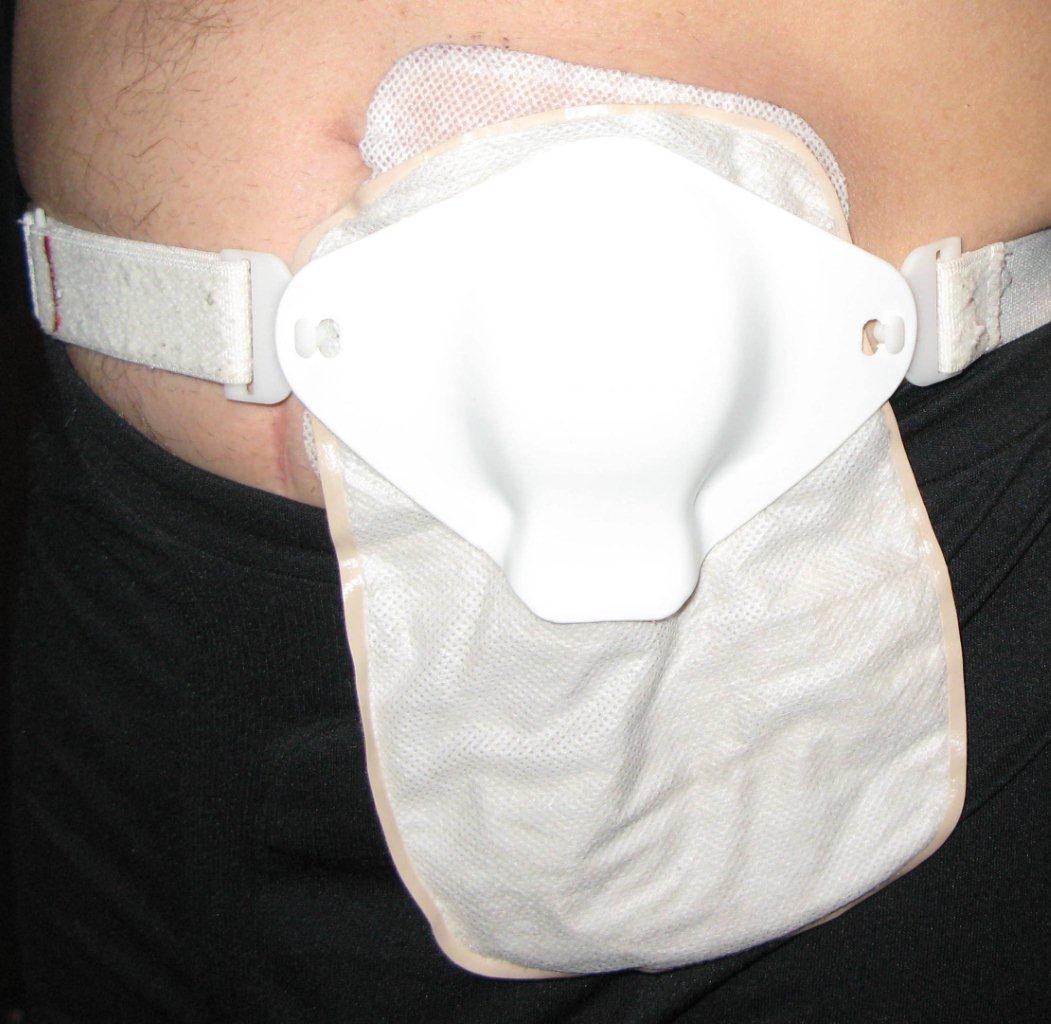 convert lbwc to awesome Ostomy Gear for BackPacking