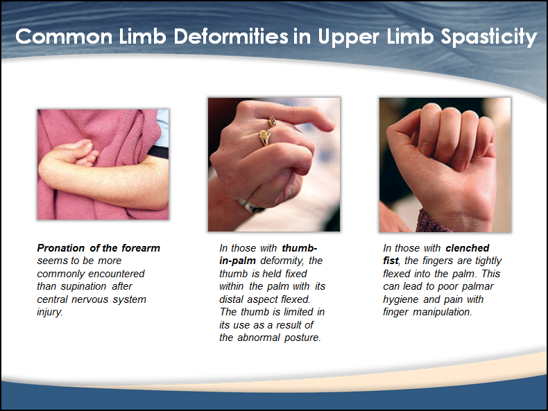 Fisioterapeuta Luís Miguel Brasão Gouveia Espasticidade/Spasticity
