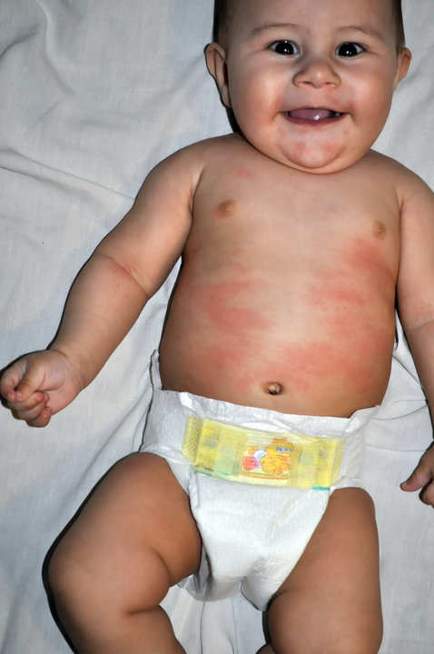 Доклад: Пищевая аллергия у детей