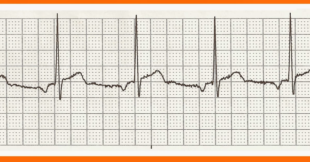 Float Nurse Practice EKG Rhythm Strips 223