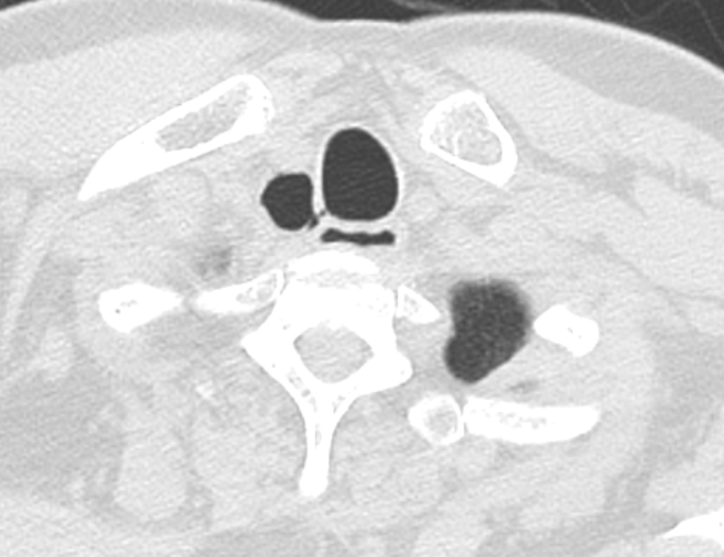 Tracheal DiverticulumCT Sumer's Radiology Blog