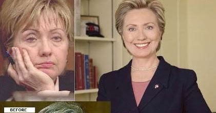 hillary botox facelift hilary