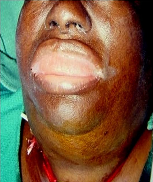 ludwig s angina