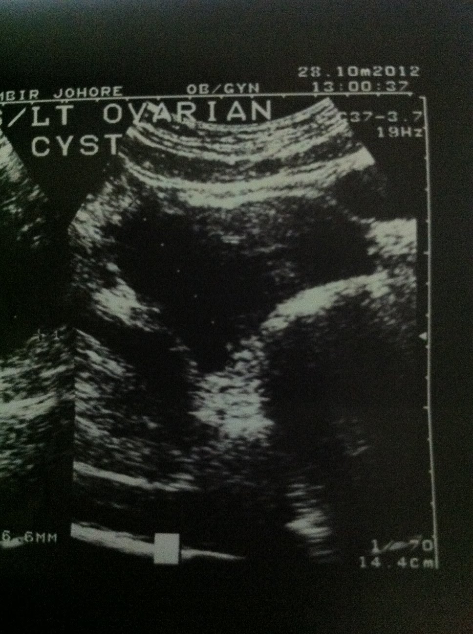 Makanan Yang Bantu Kecutkan Cyst Untuk Ibu Mengandung Farahalina Com