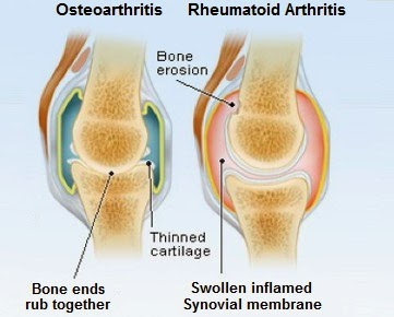 Osteoarthritis vs. Rheumatoid Arthritis