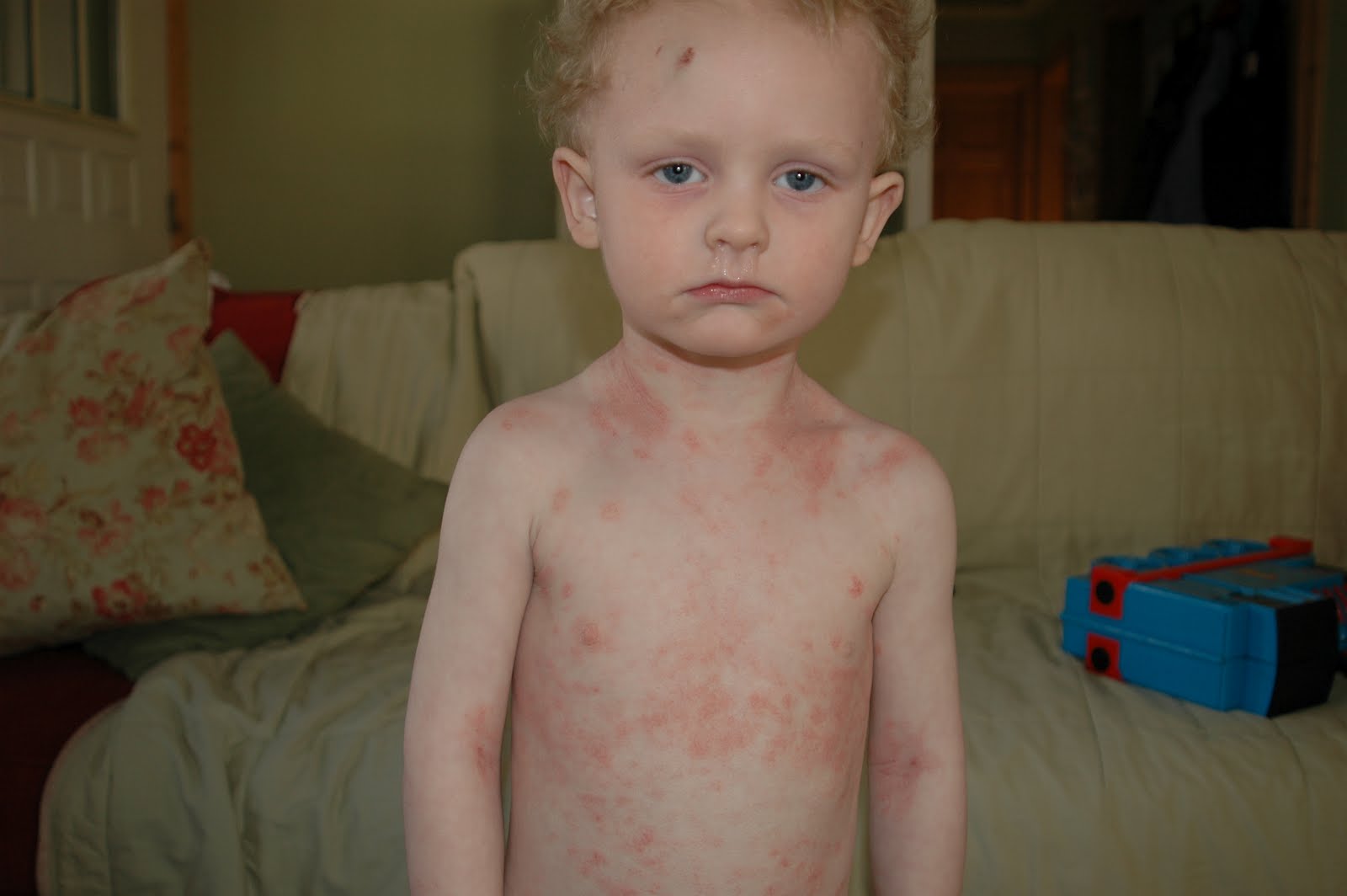 Kline's road from out of control eczema to topical steroid withdrawal