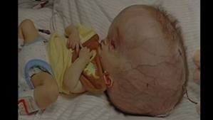 Video : 11month Old Baby Born With Huge Head