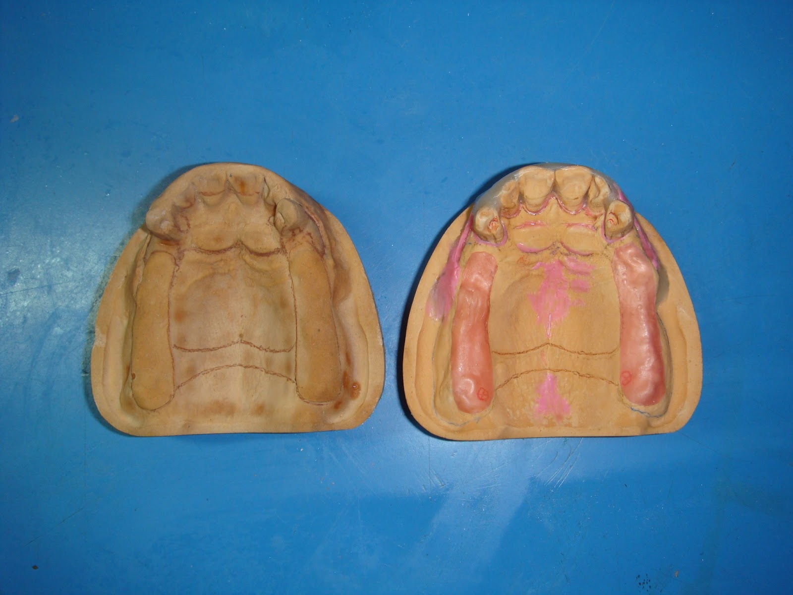 Step by step Guide for Understanding the Prosthodontics A step by step