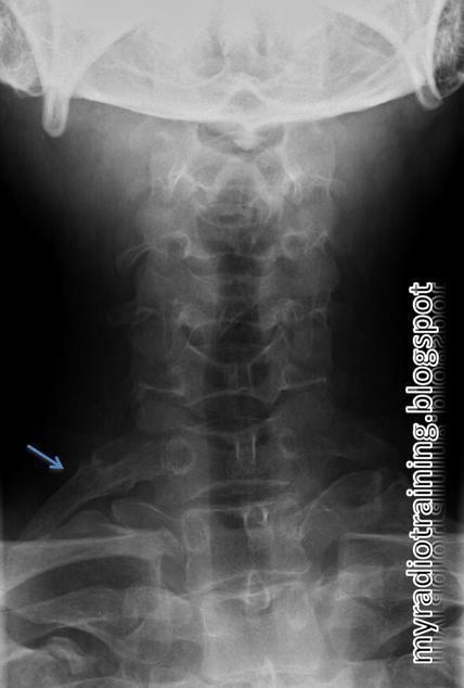 Radiology info hub: Normal Variant: Cervical Rib