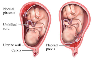 placenta previa placenta previa jalan lahir tertutupi oleh placenta
