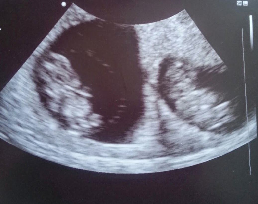 for all things creative! My Twin Pregnancy Journey TRIMESTER 1